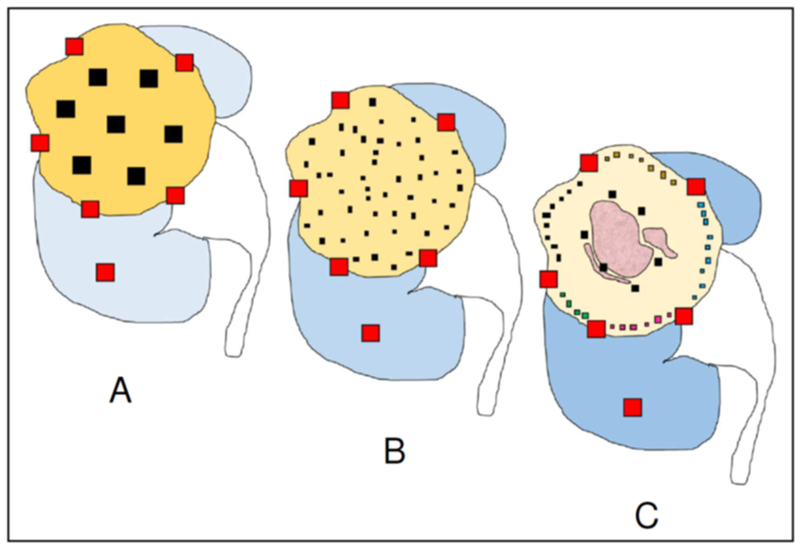 Towards Personalized Sampling in Clear Cell Renal Cell