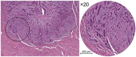 The Emerging Impact of Tumor Budding in Oral Squamous Cell Carcinoma ...