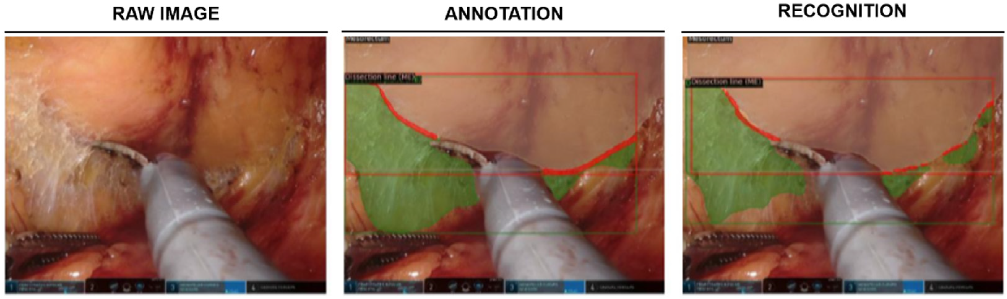 1111¥ Artificial Intelligence in Colorectal Cancer Surgery