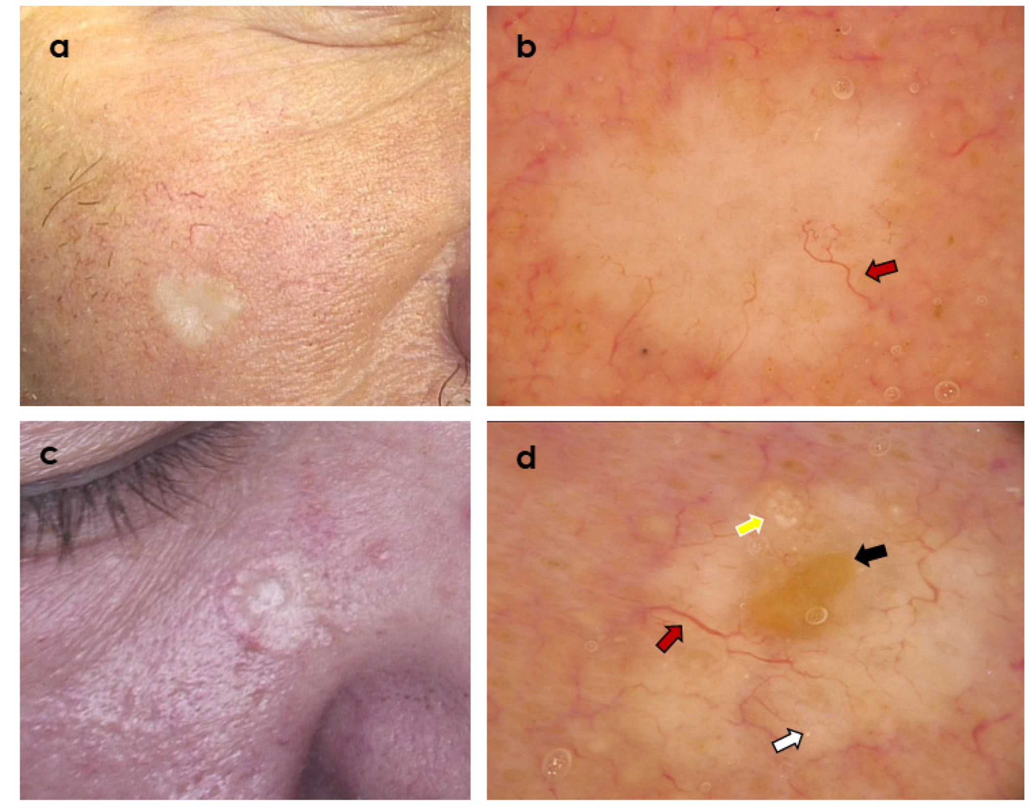 Cancers Free Full Text Significance Of Dermoscopy In Association