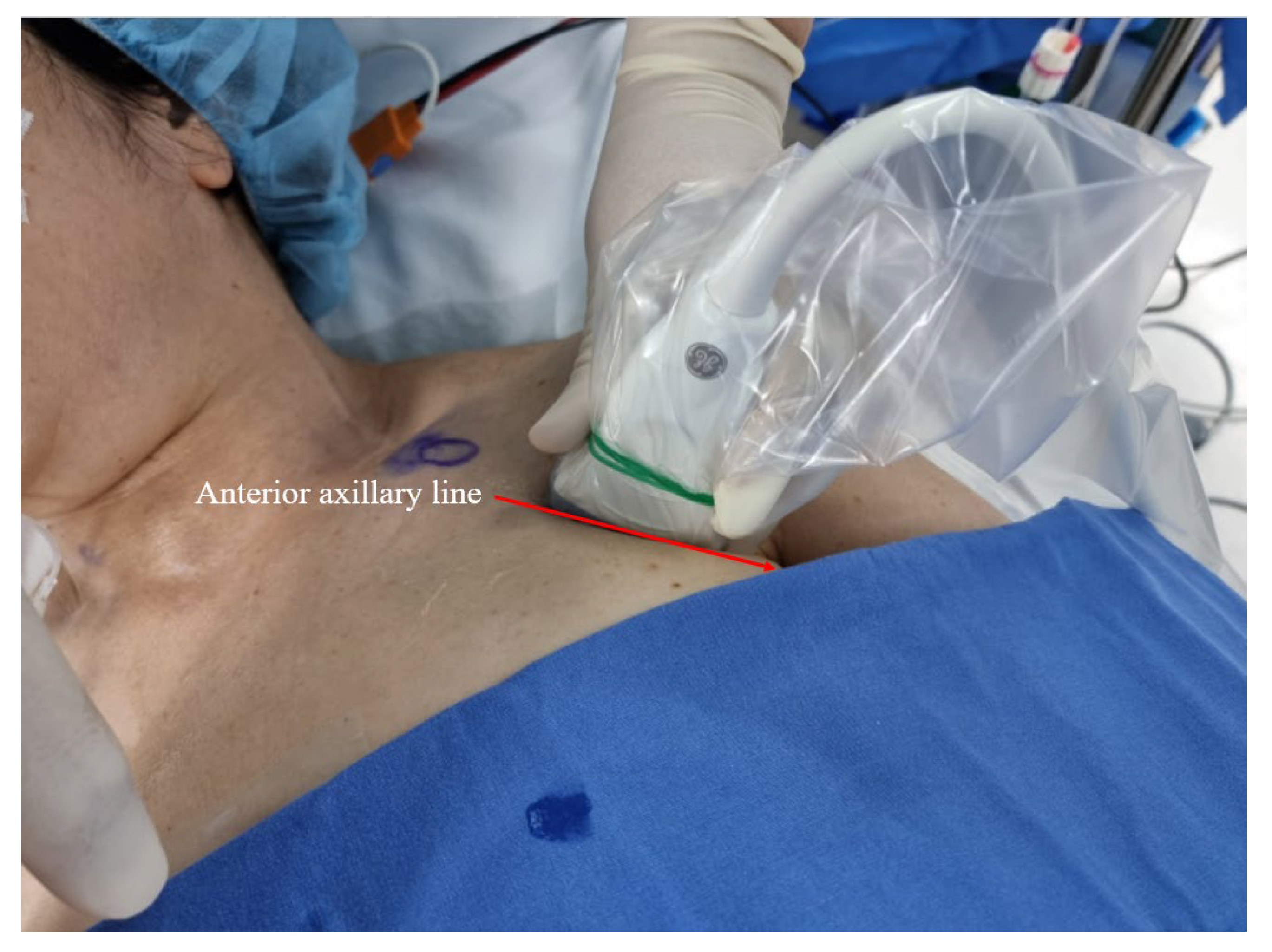 Cancers Free Full-Text Clinical Application of Pectoralis Nerve Block II for Flap Dissection-Related Pain Control after Robot-Assisted Transaxillary Thyroidectomy A Preliminary Retrospective Cohort Study