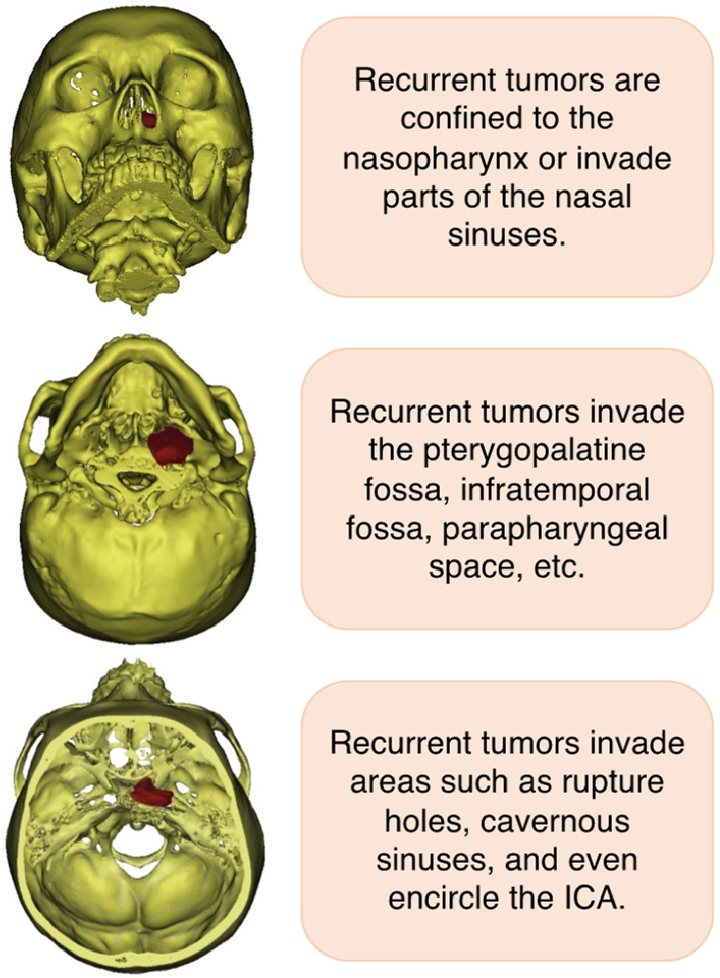 nasopharyngeal carcinoma symptoms