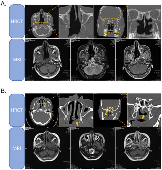 【日本製】 of Treatment Recurrent A Carcinoma: Nasopharyngeal ネイルアート用品(筆など)