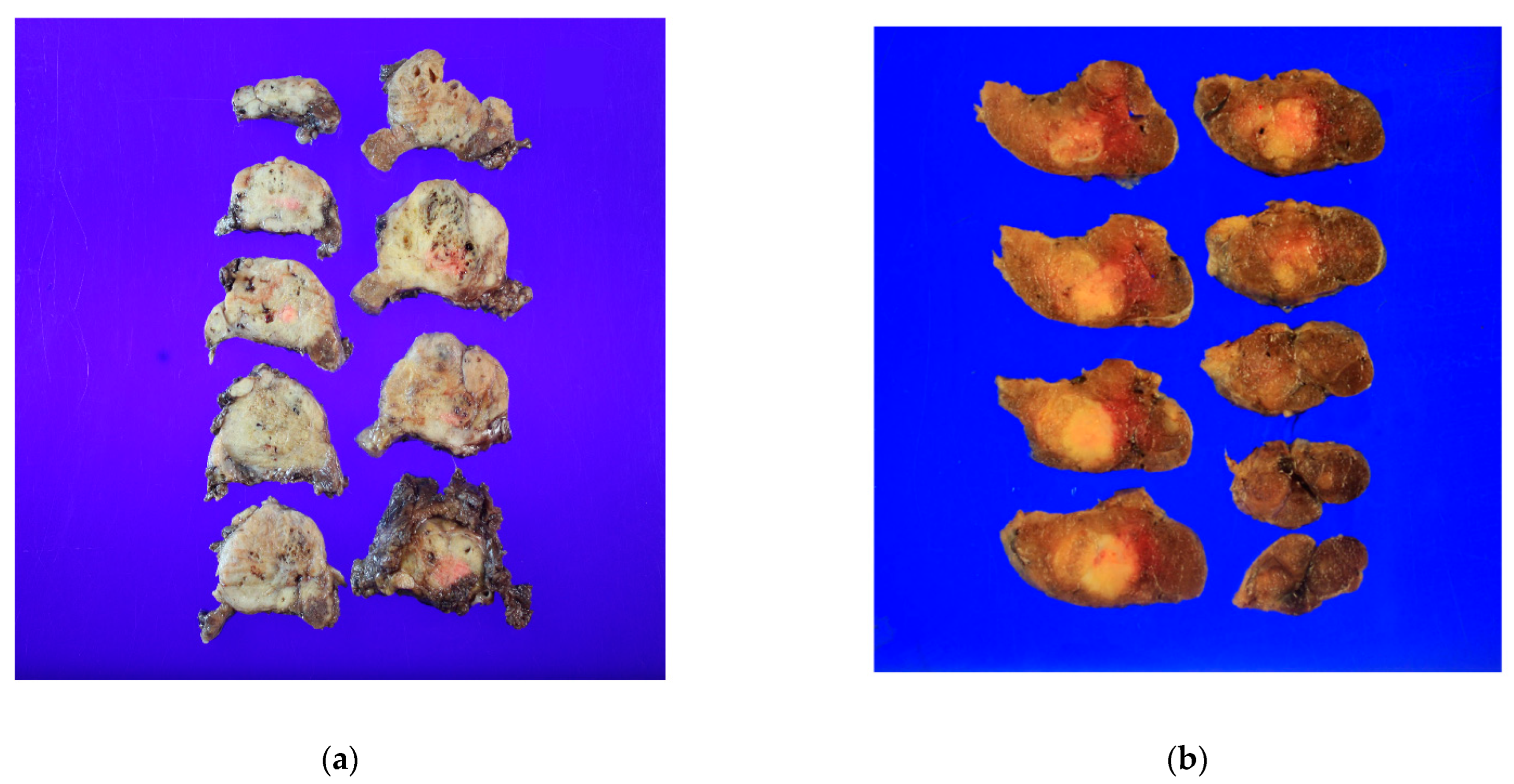 Clinical Significance of Tumor Size in Gross Extrathyroidal