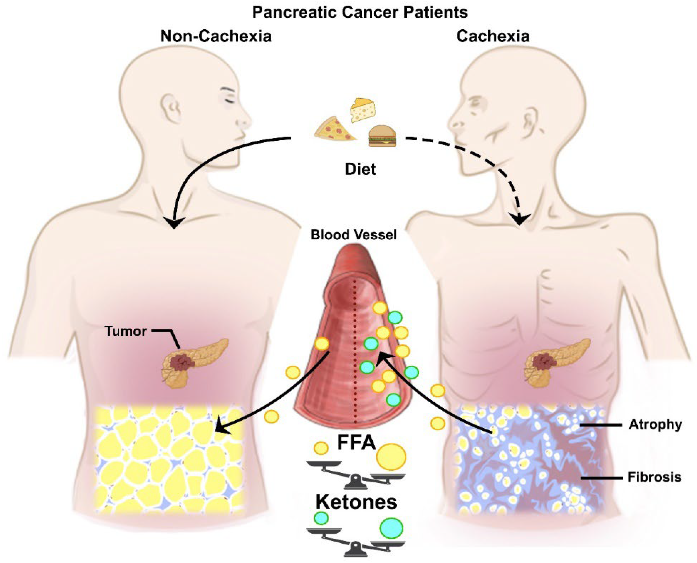 Cancers Free Full Text Adipose Tissue Wasting As A Determinant Of cancers-free-full-text-adipose-tissue-wasting-as-a-determinant-of
