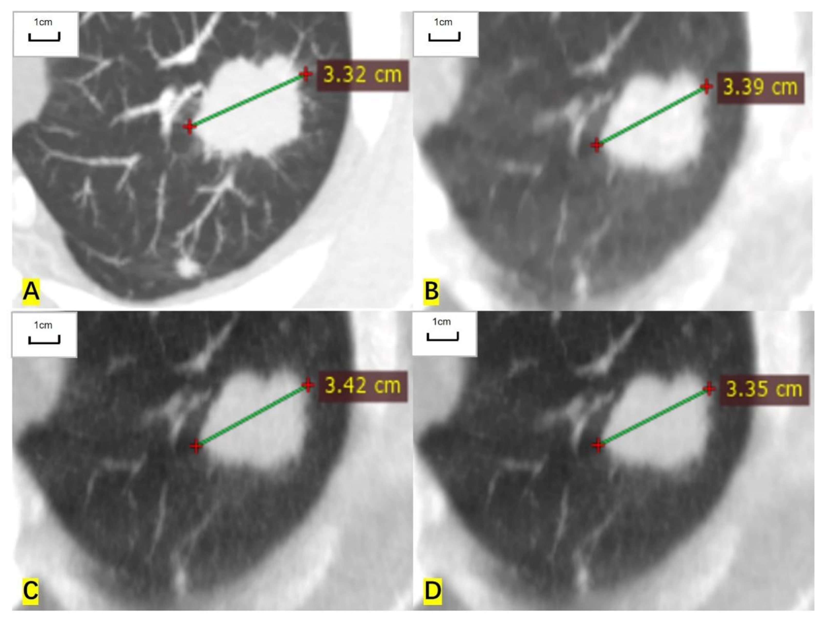 Cancers free full text measurement accuracy and repeatability of