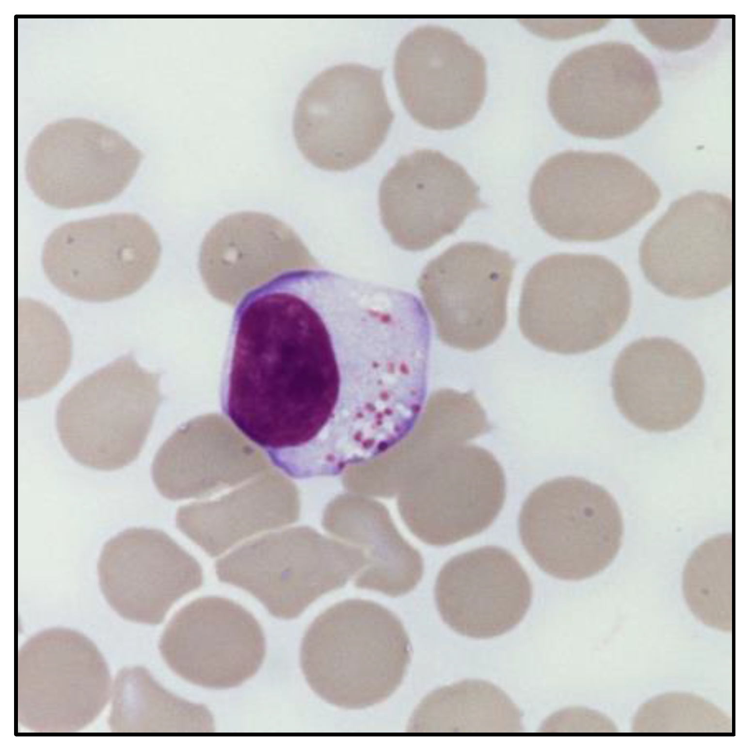 Cancers | free full-text | lgl clonal expansion and unexplained