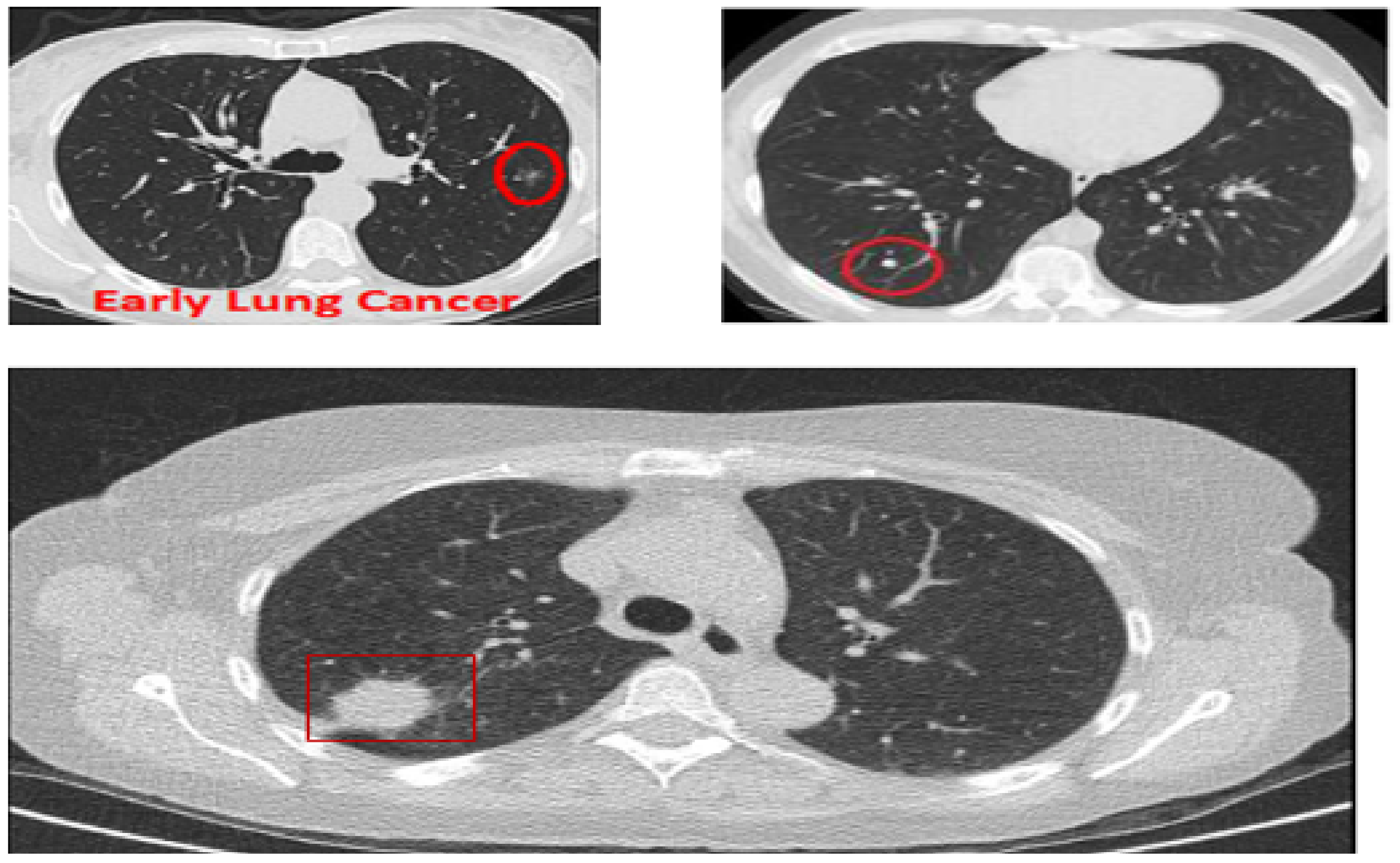 Cancers | Free Full-Text | Effective Method for Lung Cancer Diagnosis CT Using Deep Learning-Based Support Vector Network