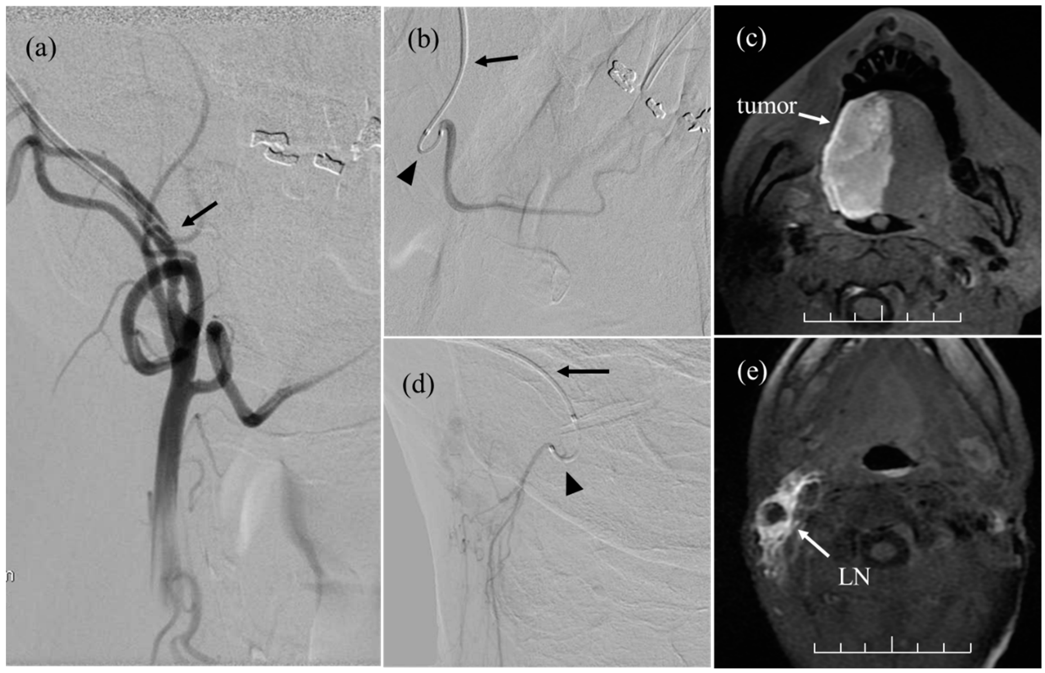 Cancers Free FullText Initial Experience of IntraArterial