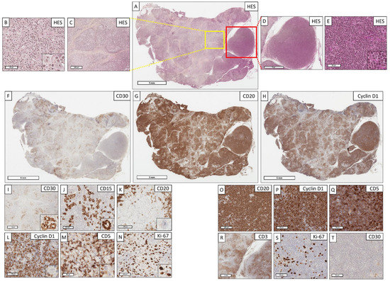 Plasticity in Classical Hodgkin Composite Lymphomas: A Plasticity in Classical Hodgkin Composite Lymphomas: A