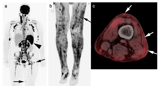 PET-CT in Clinical Adult Oncology: I. Hematologic Malignancies