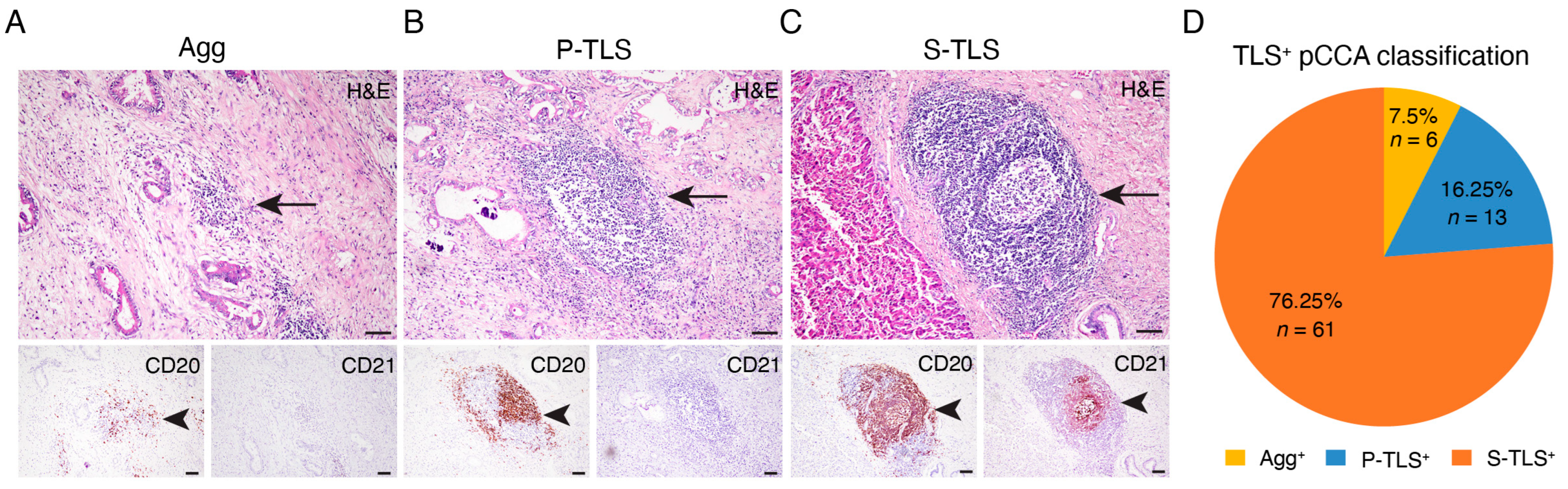 Tumor Intra-Tumoral Secondary Follicle-like Tertiary Lymphoid