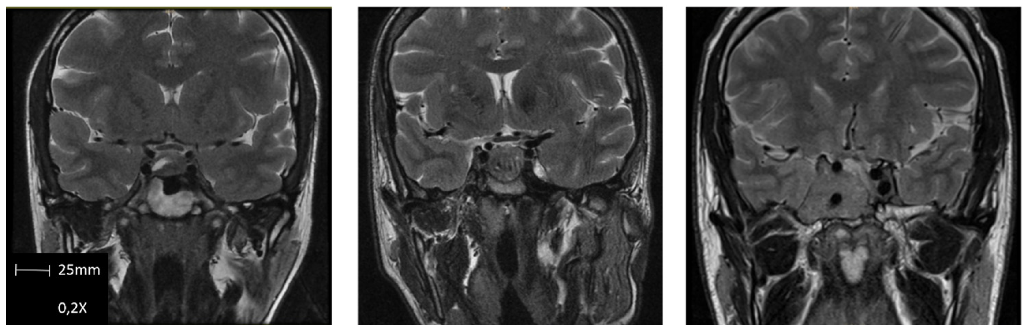 The Prognostic-Based Approach in Growth Hormone-Secreting