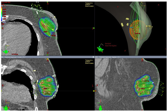 健康・医学 Radiotherapy Techniques in Breast Cancer Special Techniques of Adjuvant Breast Carcinoma Radiotherapy