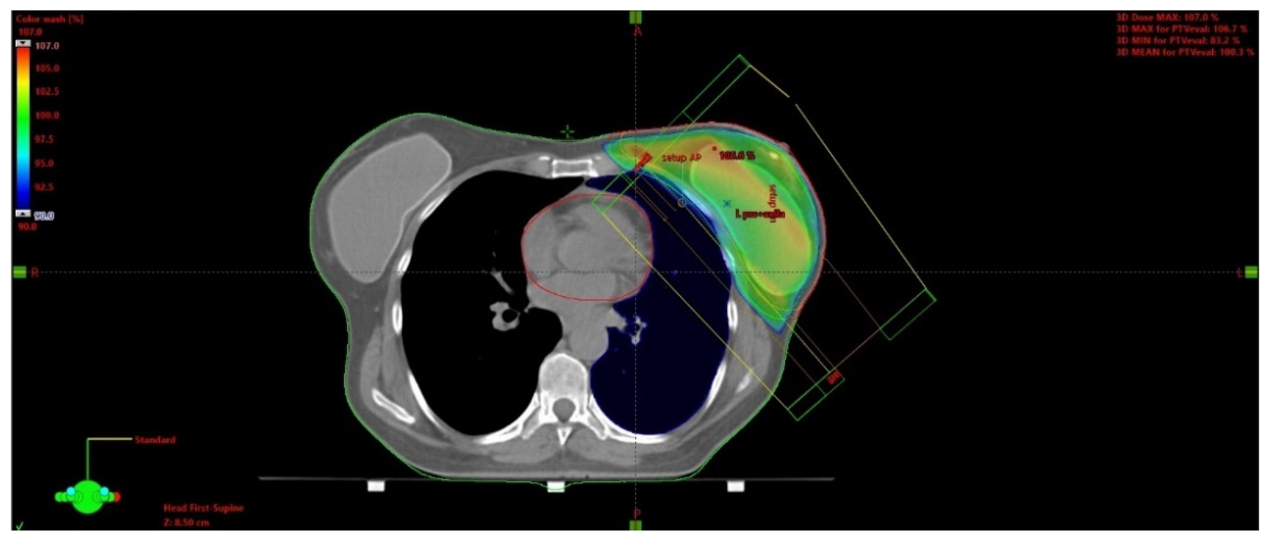 健康・医学 Radiotherapy Techniques in Breast Cancer Special Techniques of Adjuvant Breast Carcinoma Radiotherapy