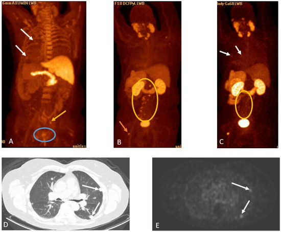 Prostate Cancer—PET Imaging Update