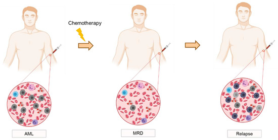 Current and Emerging Techniques for Diagnosis and MRD Detection in AML ...