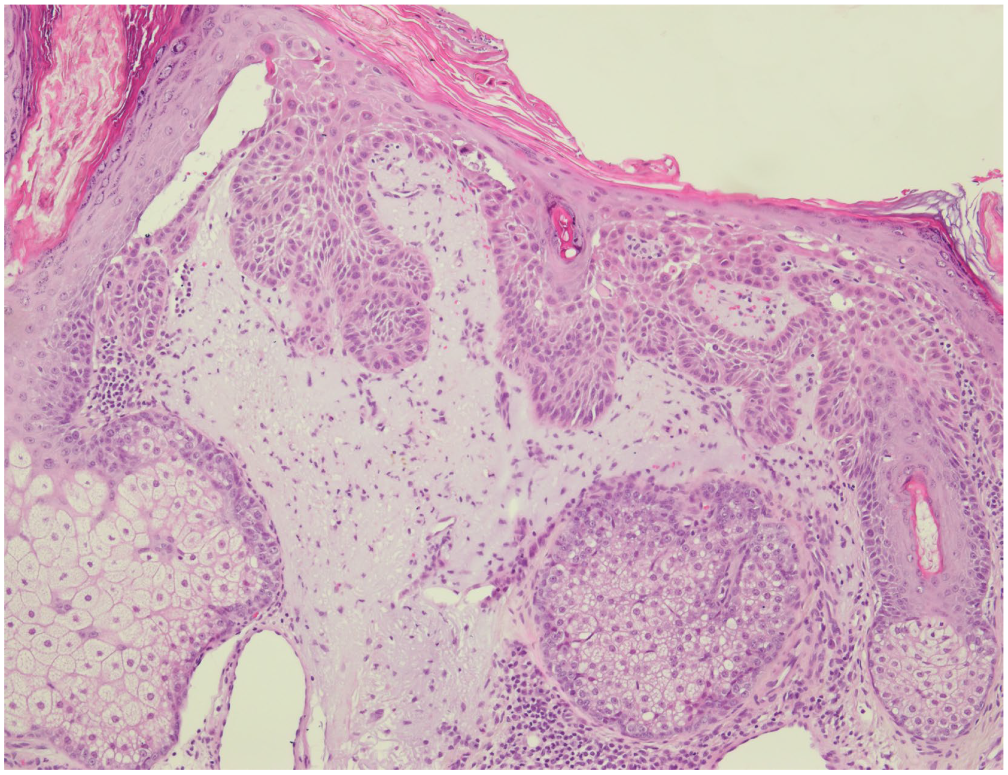 Cancers | Free Full-Text | Basal Proliferation and Acantholysis May  Represent Histological High-Risk Factors for Progression into Invasive  Squamous Cell Carcinoma: A Comparison Study in Solid Organ Transplant  Recipients and Matched Immunocompetent