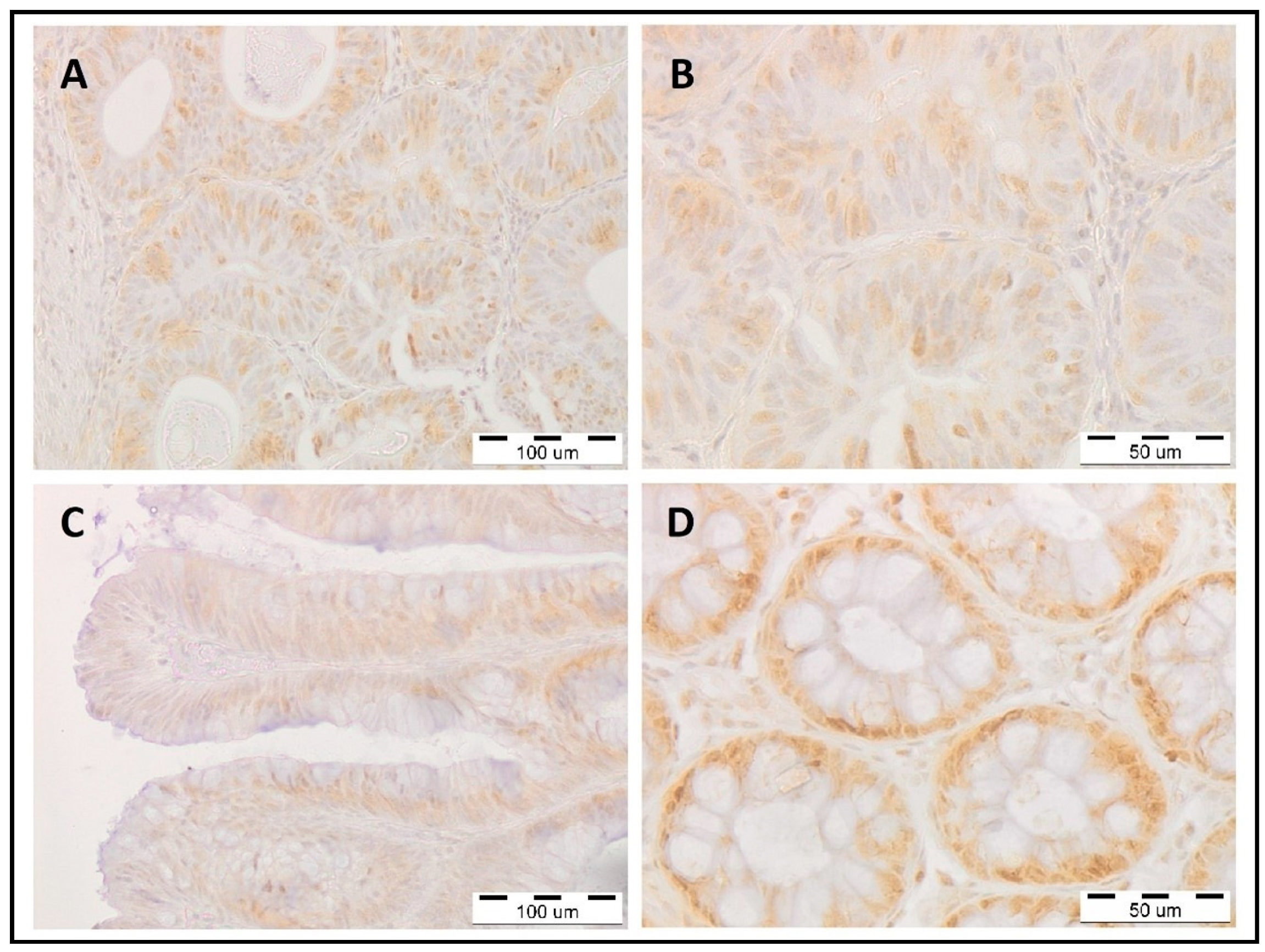 Prospects of POLD1 in Human Cancers: A Review