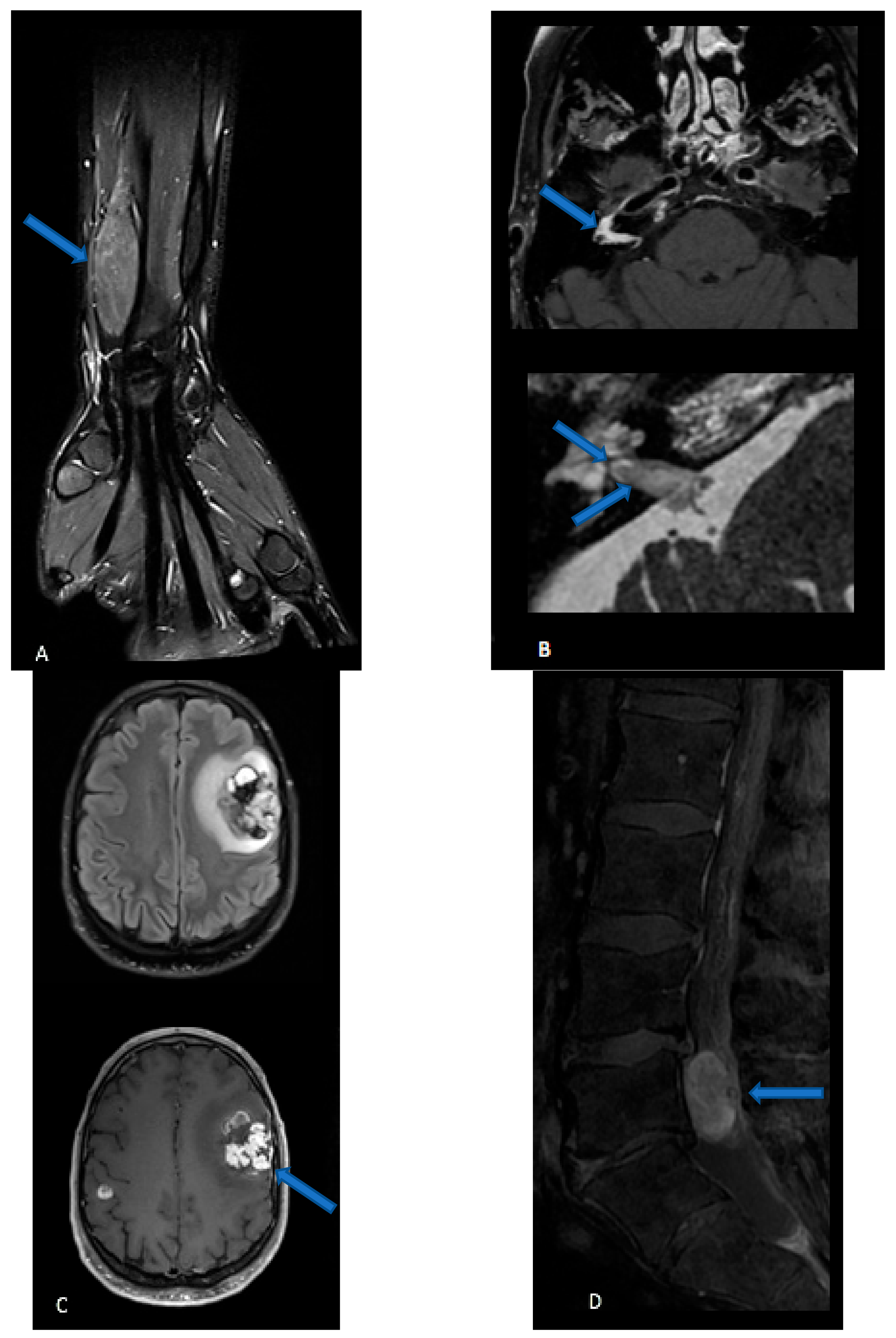 Congenital spinal dermal tract: how accurate is clinical and radiological  evaluation? in: Journal of Neurosurgery: Pediatrics Volume 15 Issue 6  (2015) Journals