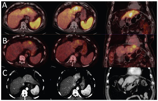 Update on PET Radiopharmaceuticals for Imaging Hepatocellular Carcinoma