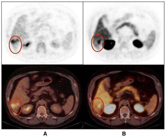 Update on PET Radiopharmaceuticals for Imaging Hepatocellular Carcinoma