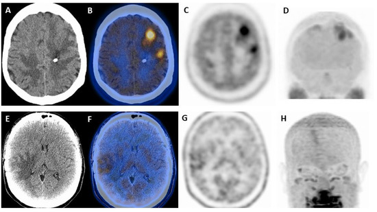 The Role of Molecular Imaging in Patients with Brain Metastases: A ...