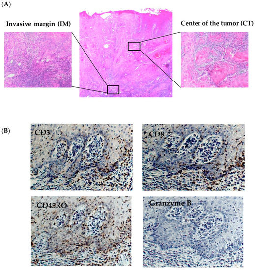 Cancers Free FullText TumorInfiltrating CD45RO+ Memory Cells Are