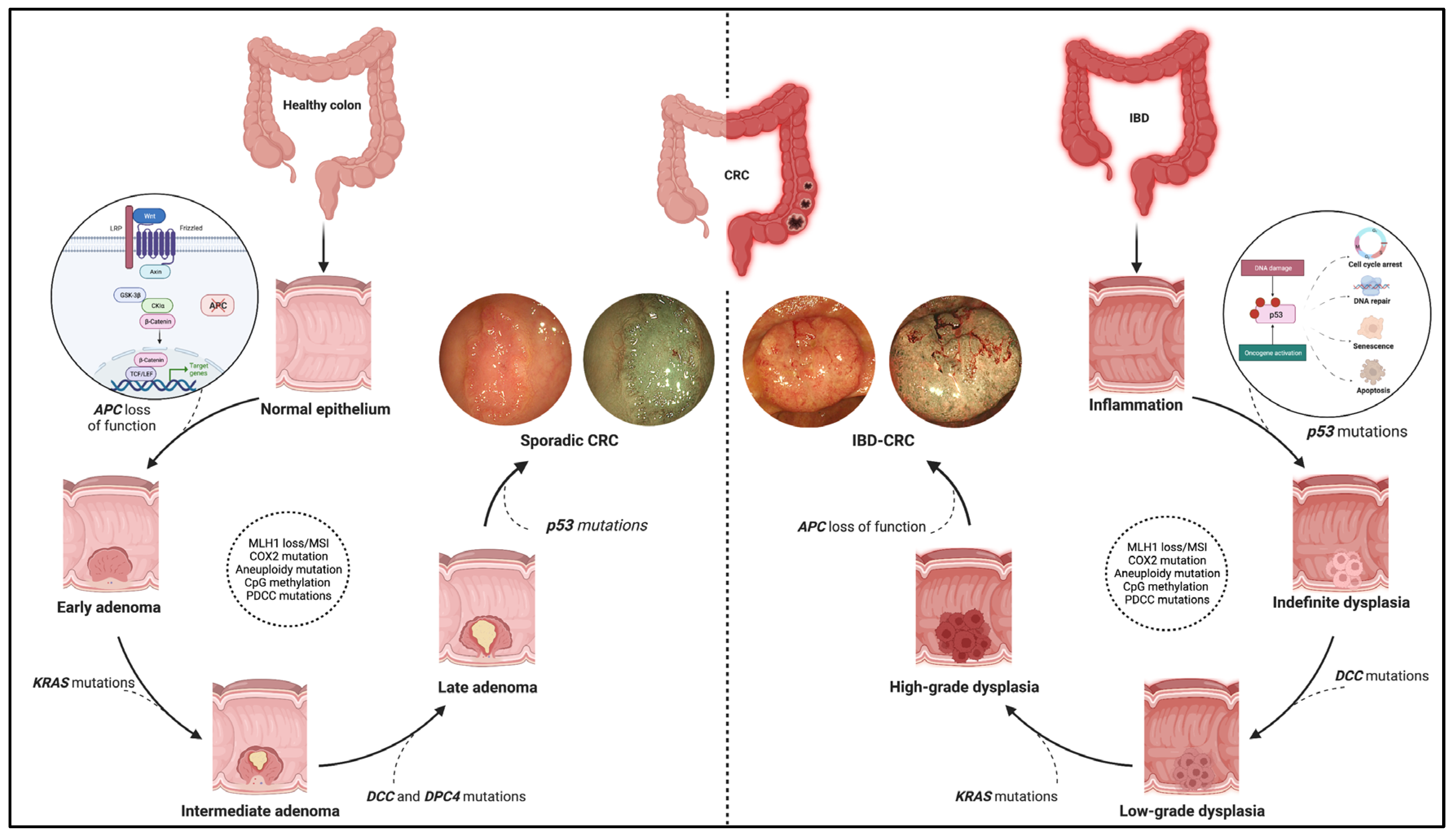 Inflammation Driven Colorectal Cancer Associated With Colitis inflammation-driven-colorectal-cancer-associated-with-colitis