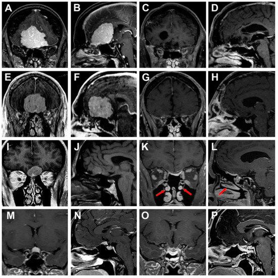 Surgical Anatomy and Approaches of the Anterior Cranial