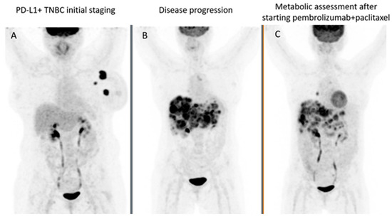 PET/CT in Patients with Breast Cancer Treated with Immunotherapy