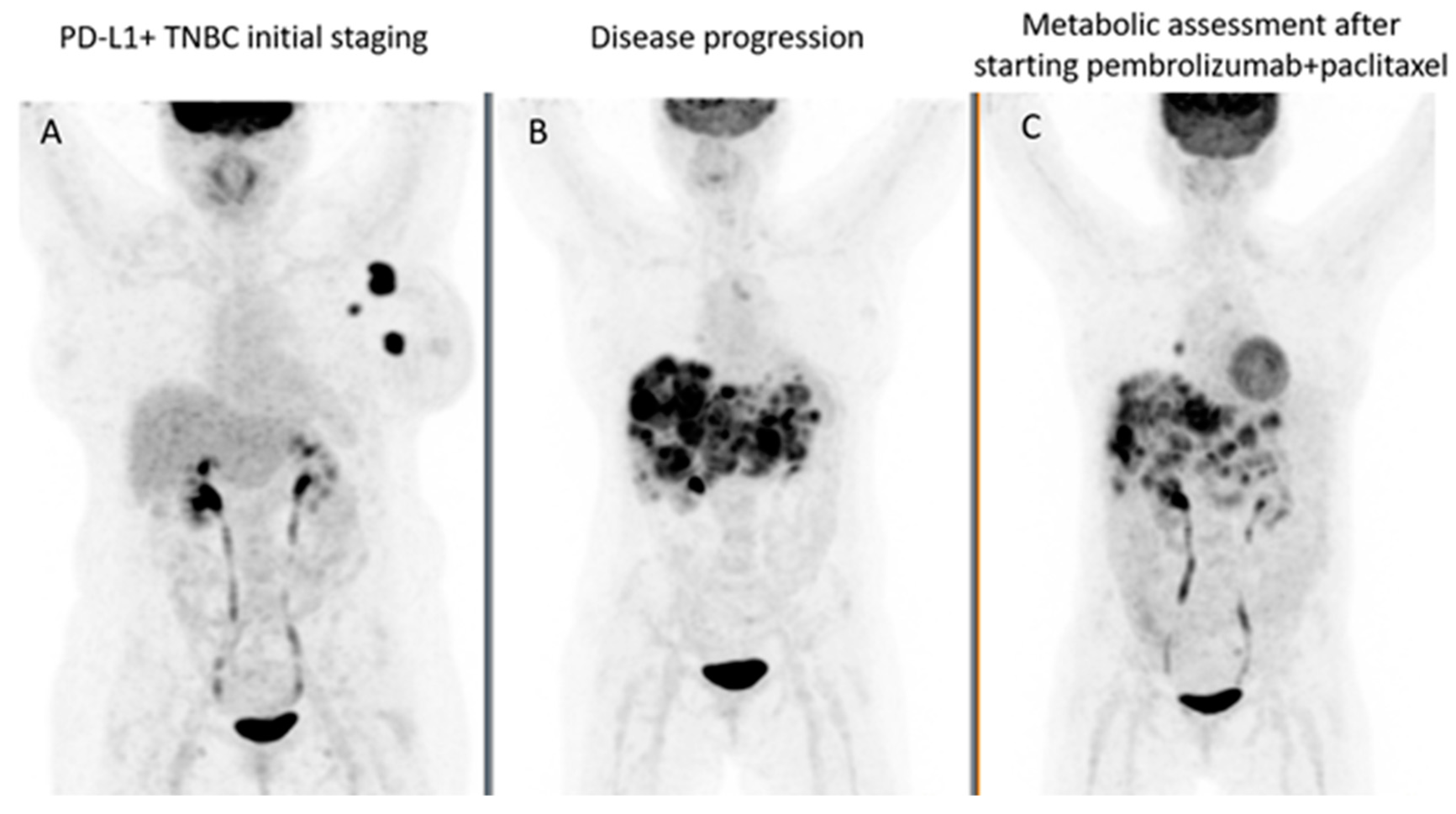 PET/CT in Patients with Breast Cancer Treated with Immunotherapy