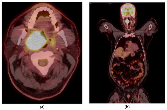 Role of PET/CT in Oropharyngeal Cancers