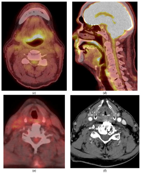 Role of PET/CT in Oropharyngeal Cancers