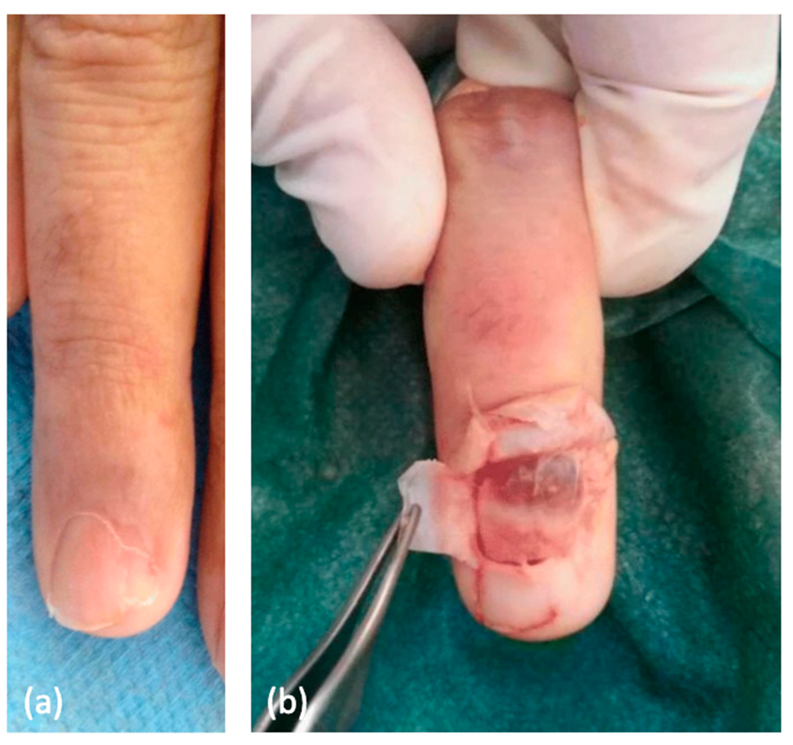 Rare Localisation of Glomus Tumor under greater Toenail Bed, presenting  with Pain for a Decade-A Case Report