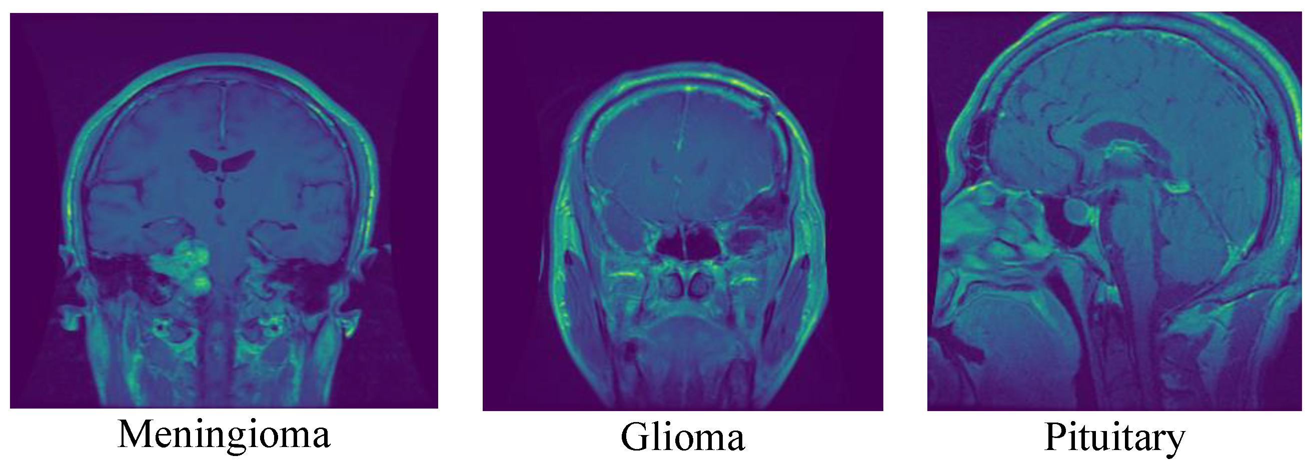 Cancers | Free Full-Text | Efficient Brain Tumor Detection with ...