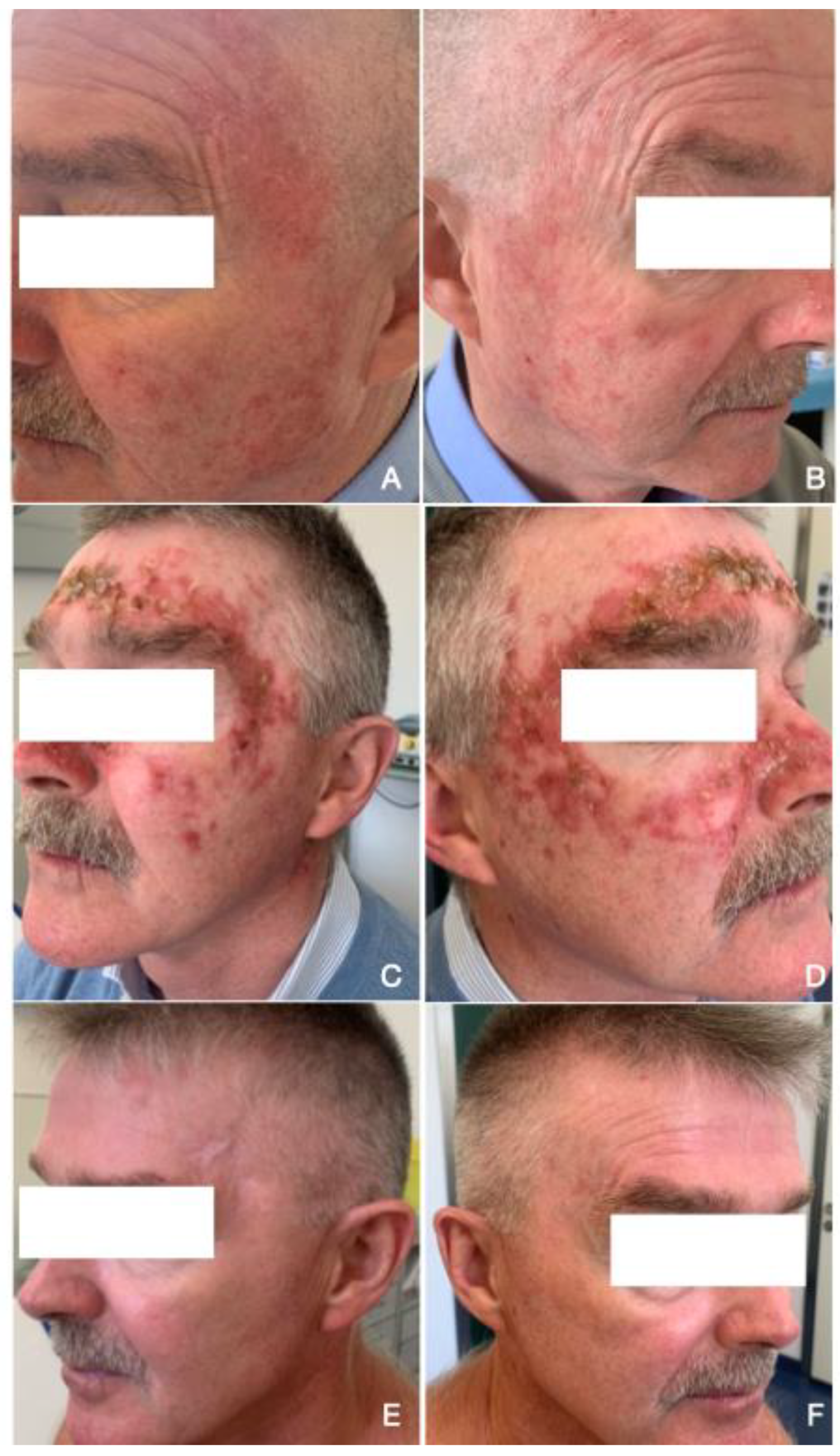 Cancers | Free Full-Text | Actinic Keratoses: A Prospective Pilot Study on  a Novel Formulation of 4% 5-Fluorouracil Cream and a Review of Other  Current Topical Treatment Options