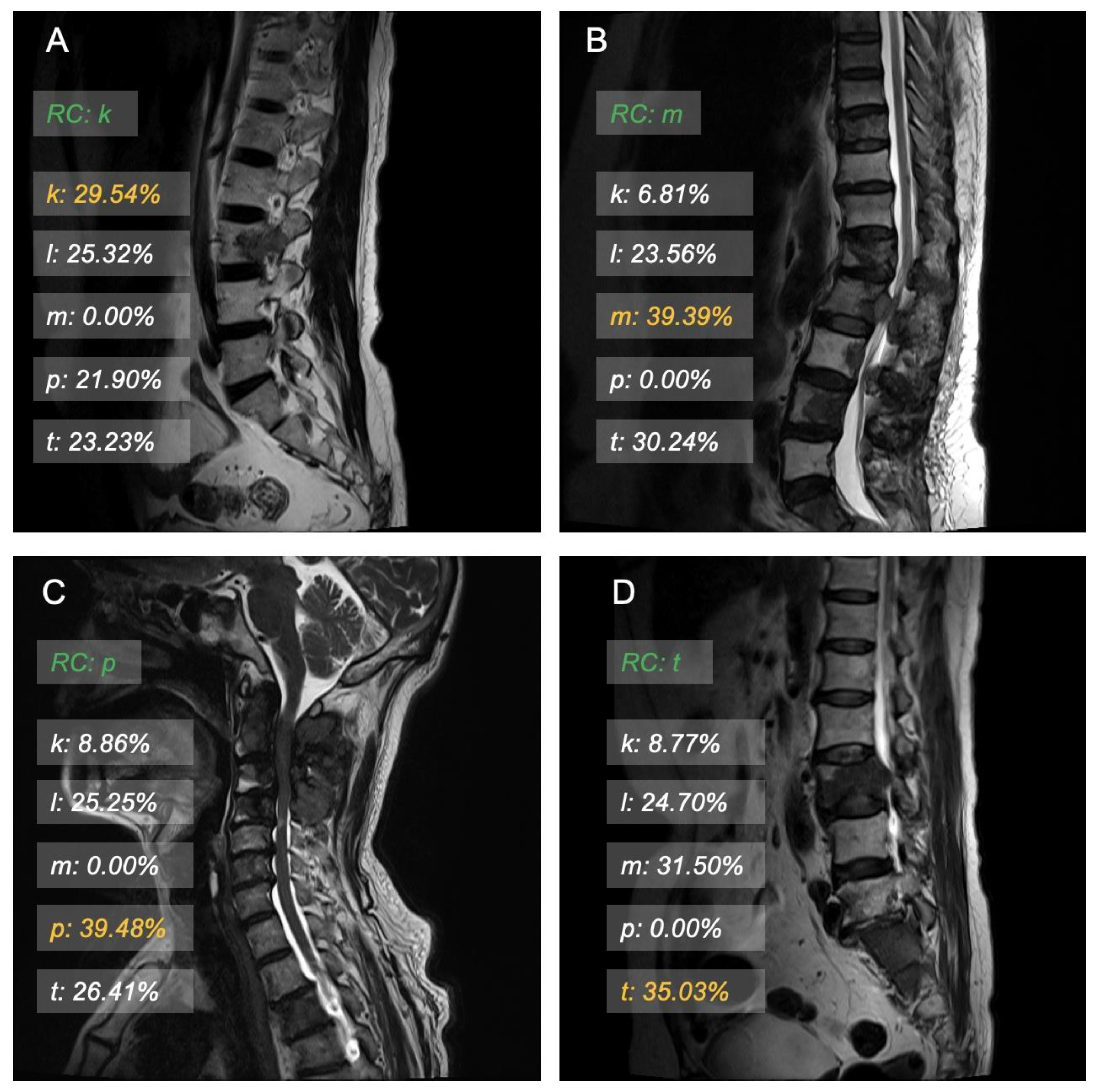 健康・医学 Cancer in the spine Metastatic Spine Tumors