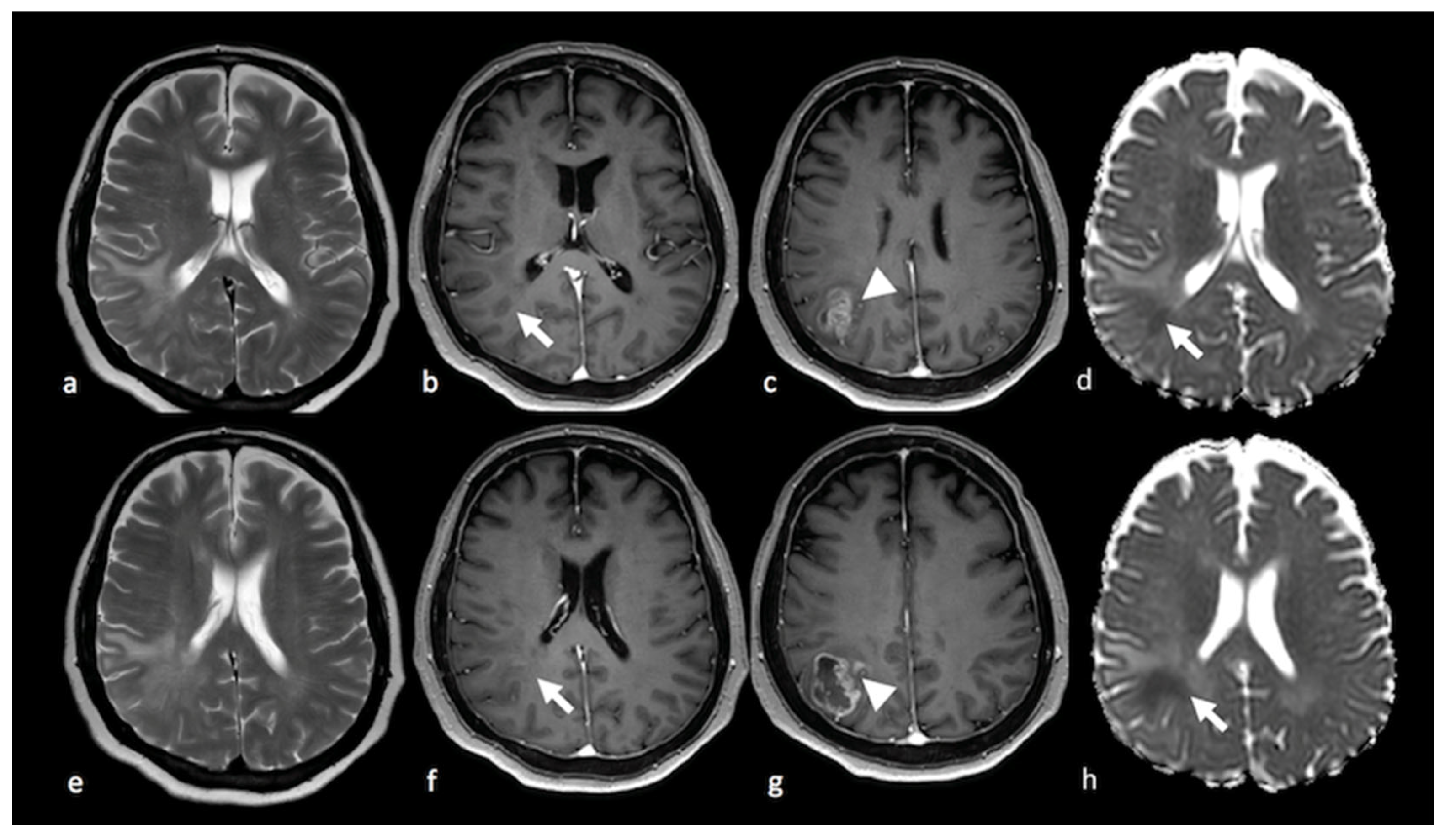 Brain MRI demonstrated intra‐axial ring‐enhancing lesions in the left... |  Download Scientific Diagram