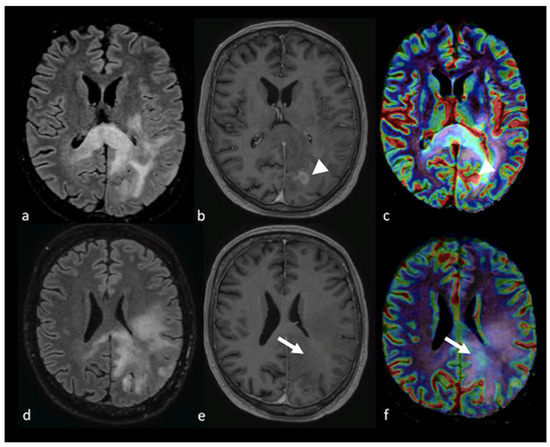 Conventional and Advanced Magnetic Resonance Imaging Assessment of  Non-Enhancing Peritumoral Area in Brain Tumor