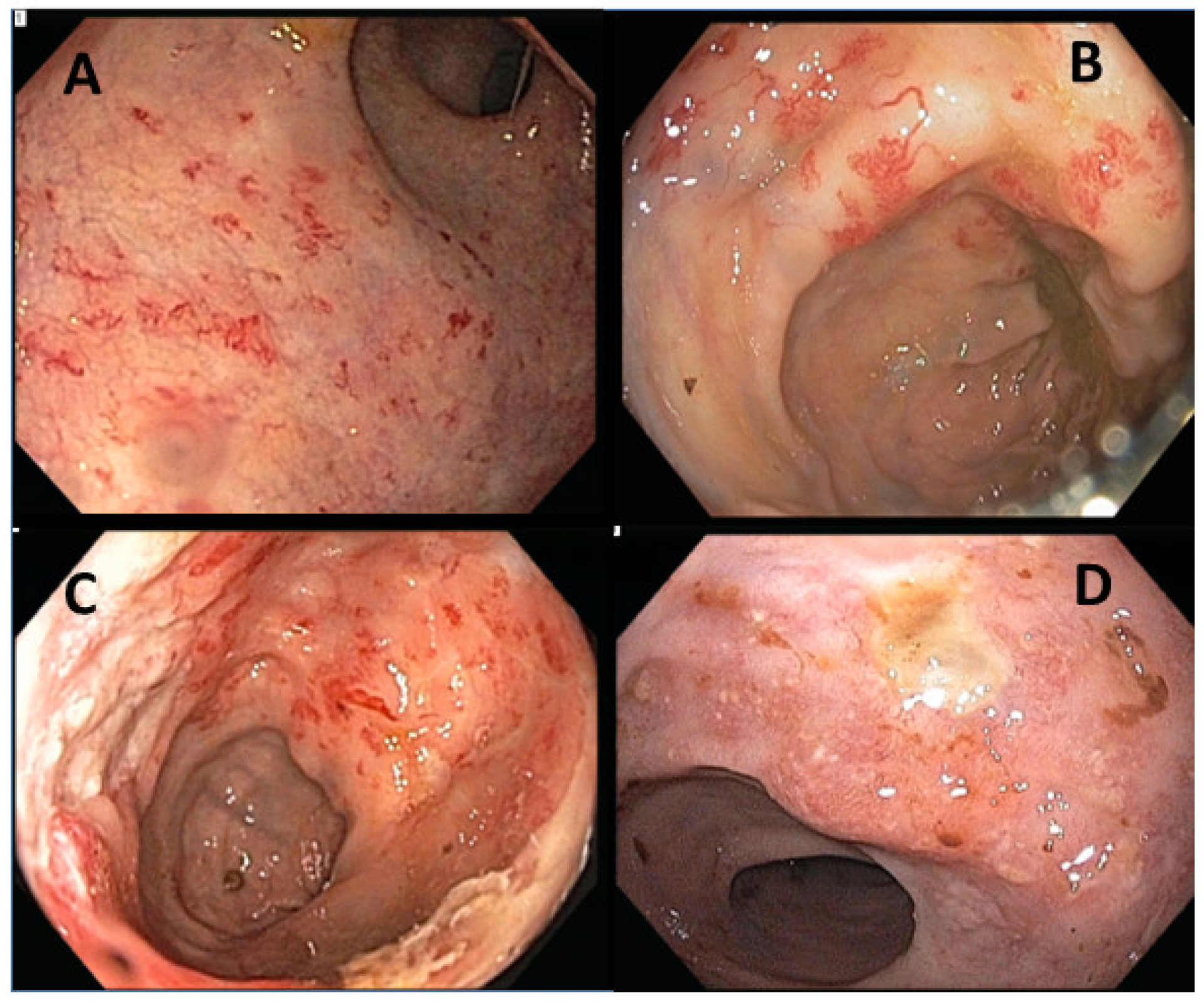 Clinical Features and Management of Acute and Chronic Radiation 