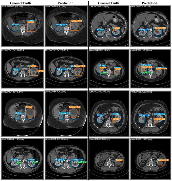 Cancers | Free Full-Text | Kidney Cancer Diagnosis and Surgery ...