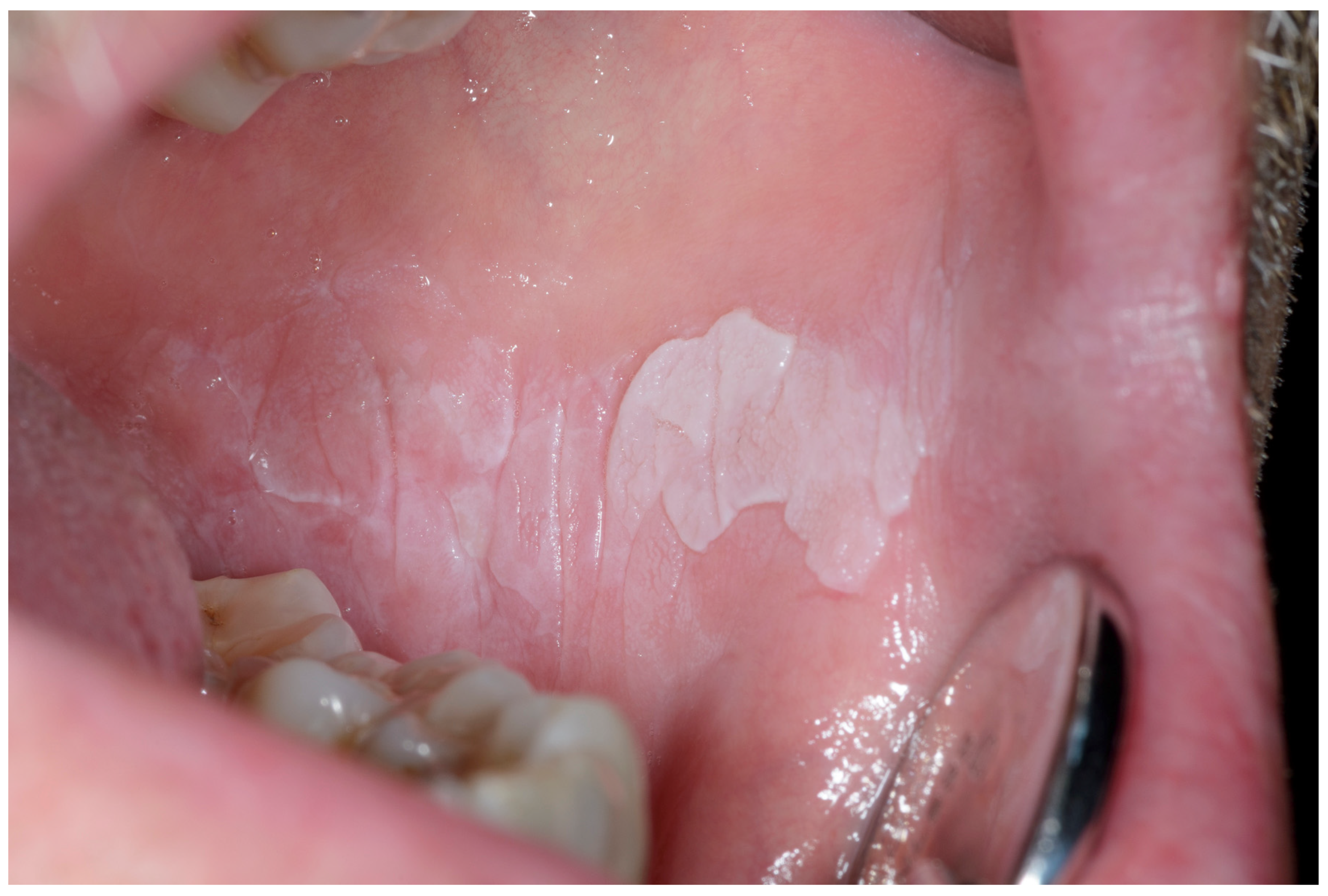 Cancers | Free Full-Text | Early Diagnosis of Oral Cancer: A Complex  Polyhedral Problem with a Difficult Solution