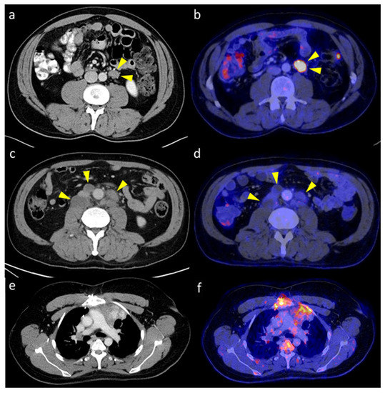 How [18F]-FDG-PET/CT Affects Clinical Management of Patients with Germ ...