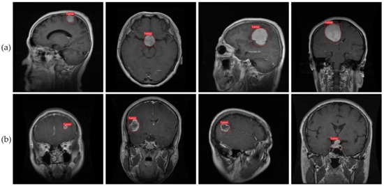 Brain Tumor Detection Based on Deep Learning Approaches and Magnetic ...