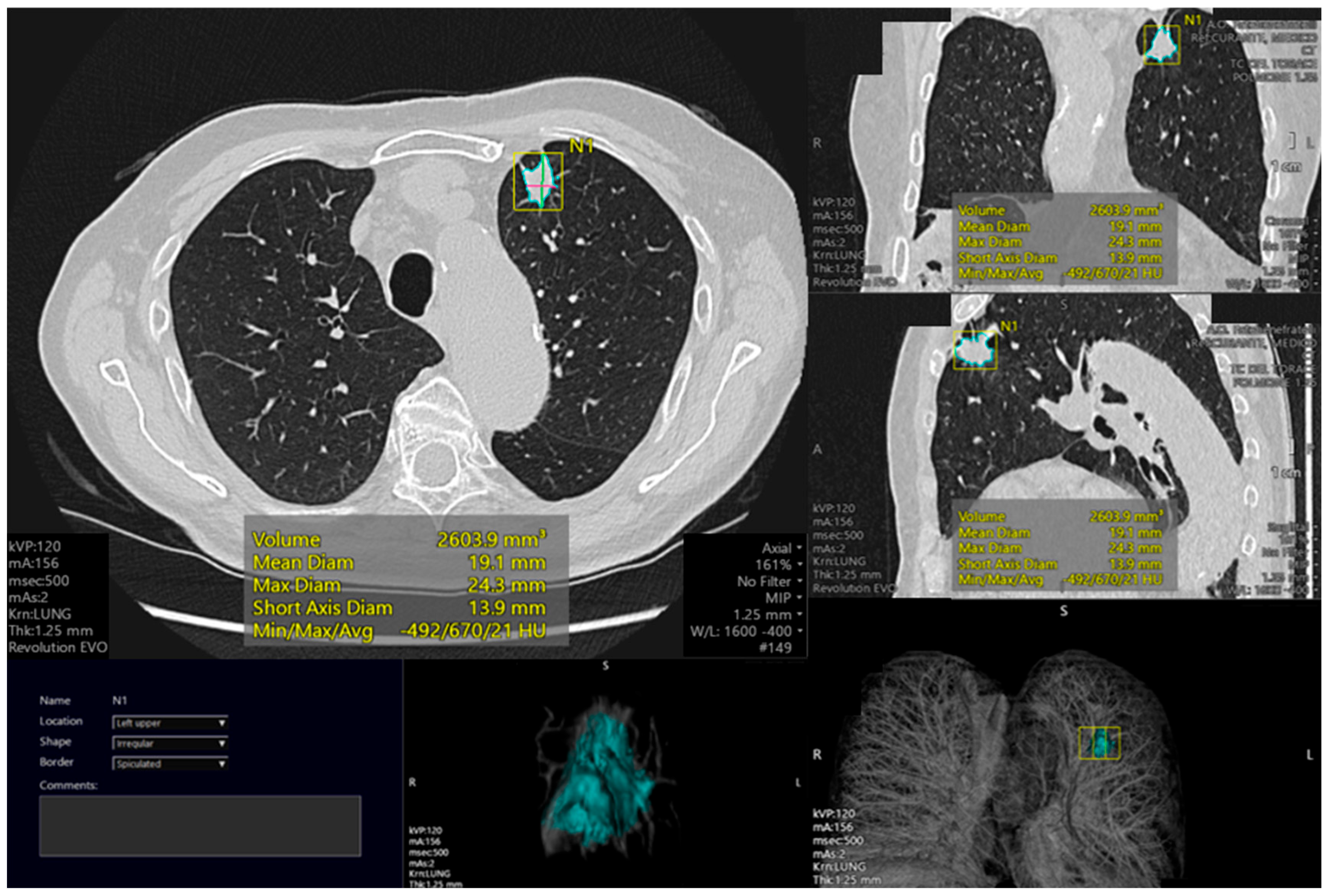 Leveraging Datature Nexus for Tumor and Anomaly Detection in Medical Scans  : Part I