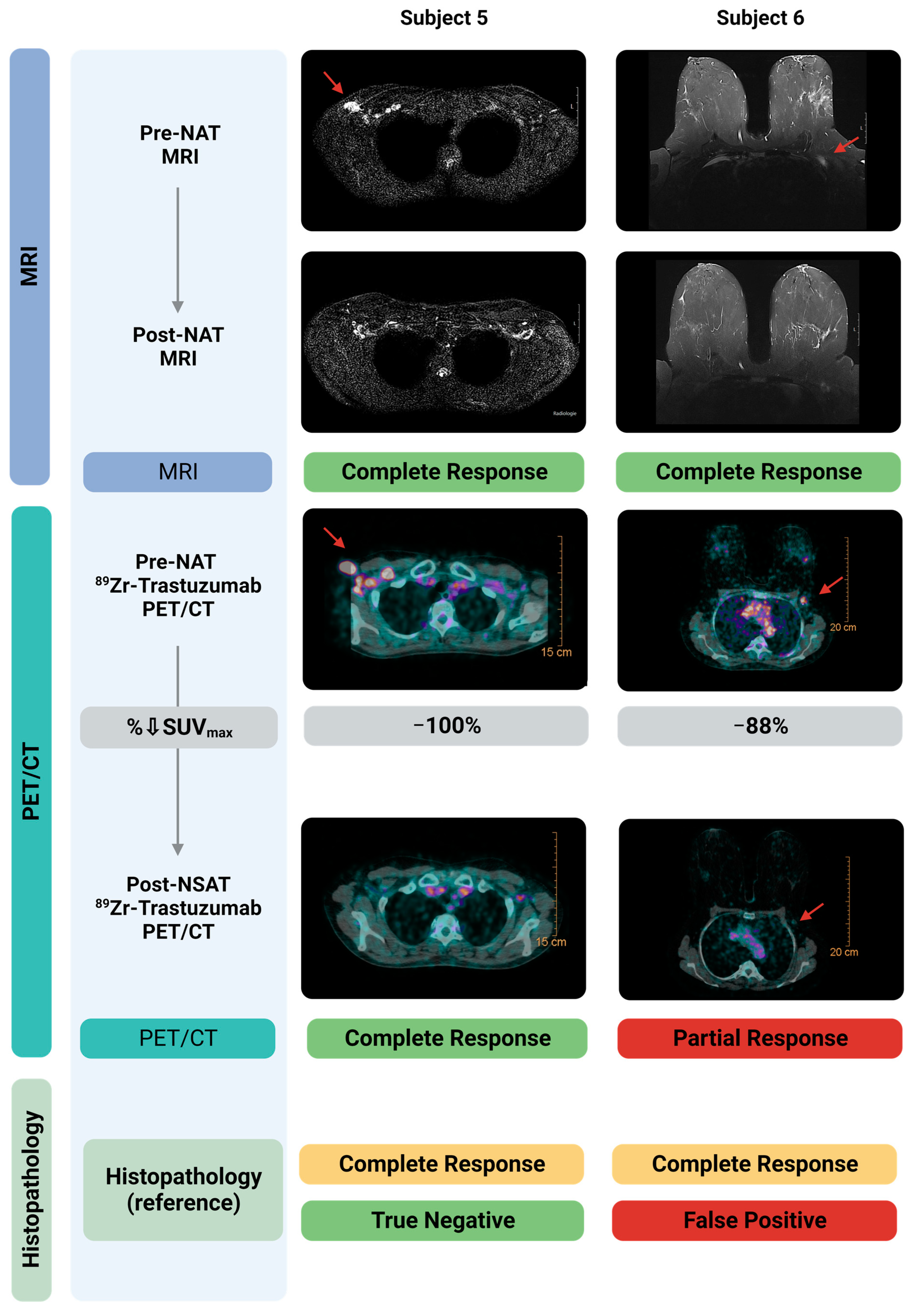 89Zr-Trastuzumab PET/CT Imaging of HER2-Positive Breast