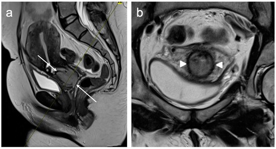 An Update on the Role of MRI in Treatment Stratification of Patients ...