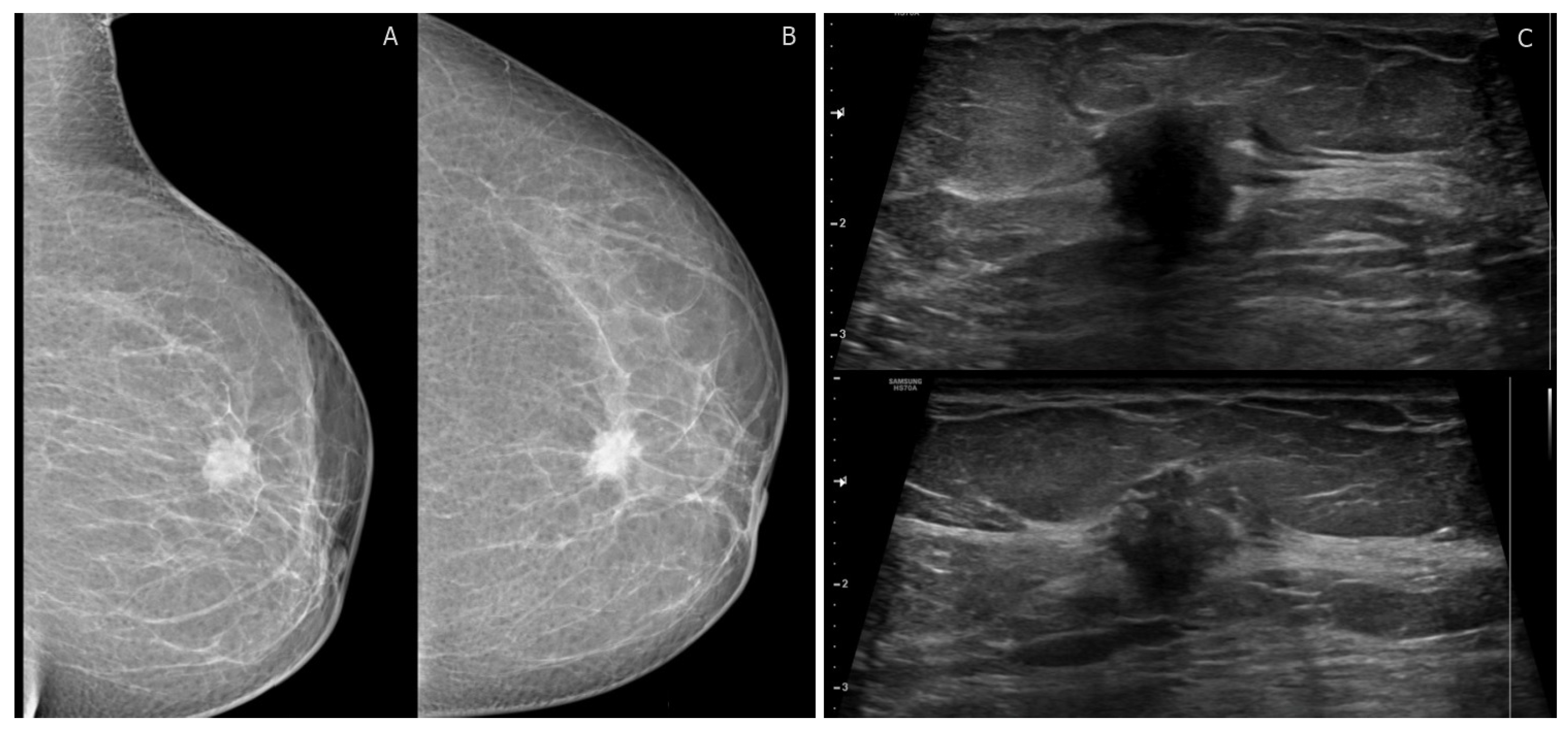 Normal breast MRI - dense breasts, Radiology Case