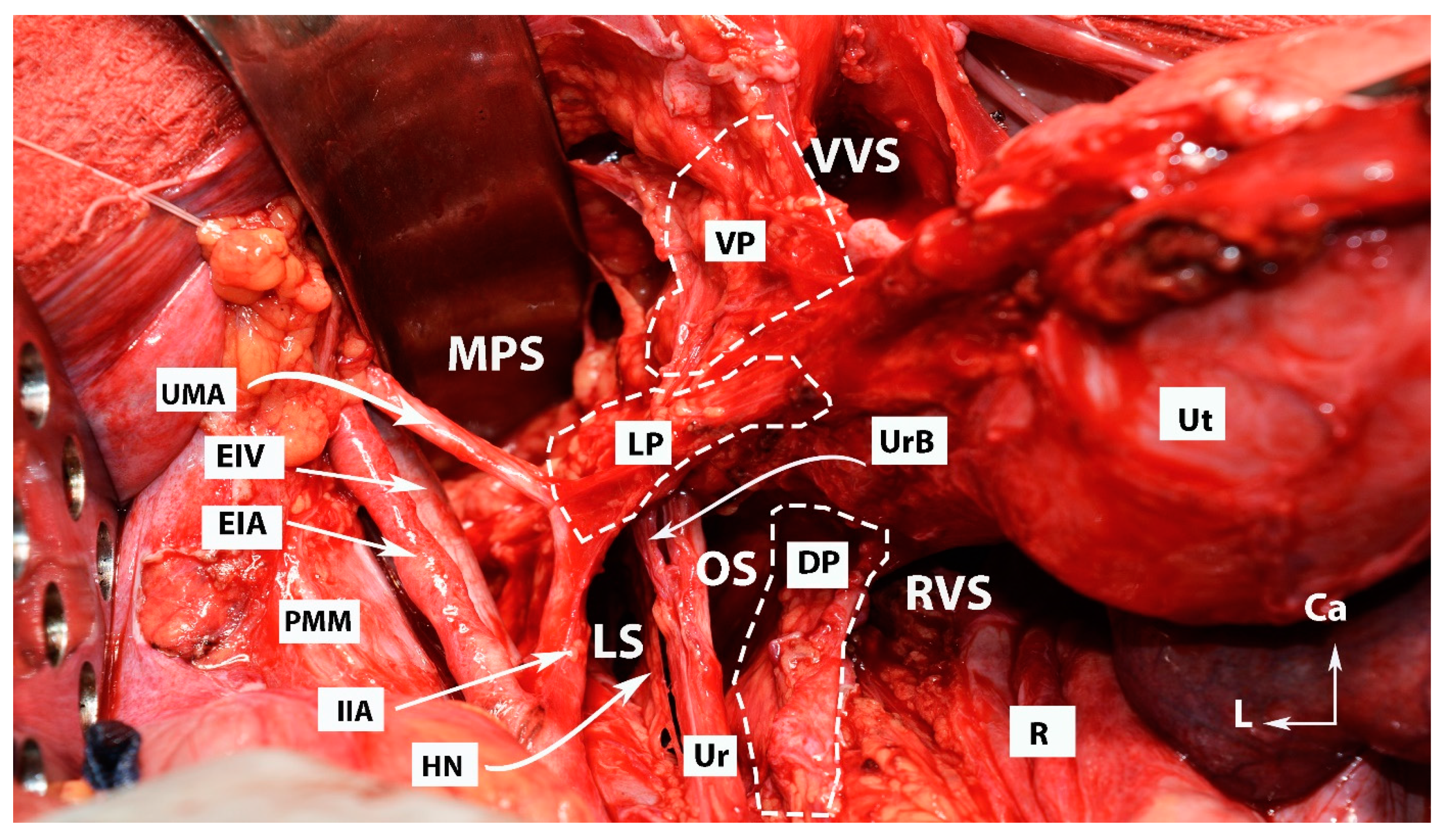 Cervix　Dissection A, Dissection of the posterior adhesions. Posterior adhesions were... |  Download Scientific Diagram
